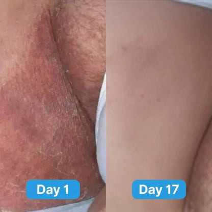 Sumifun Antifungal Cream®