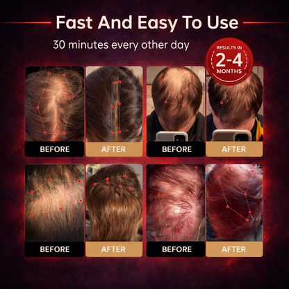 🧬Regrowth Therapy Cap – LLLT Laser Hair Growth Device for Thinning Hair (50% OFF - Now $79.99) ✨