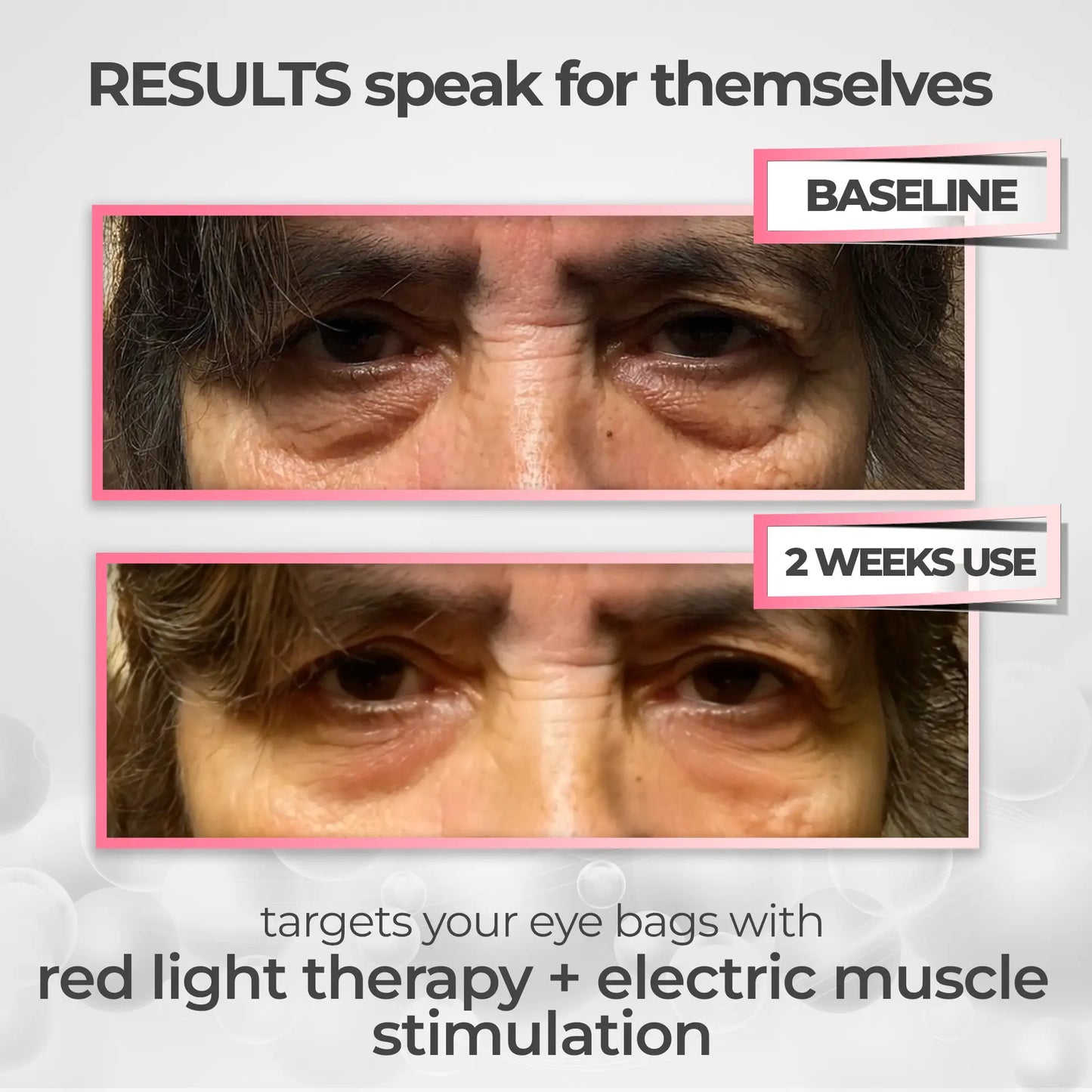 💖 Mother’s Day 70% OFF – RevitalEyes® 2-in-1 Red Light + EMS Eye Bag Remover