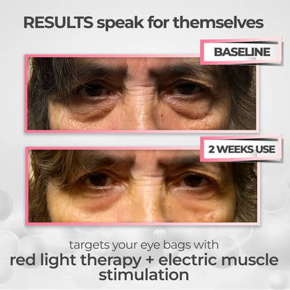 💖 Mother’s Day 70% OFF – RevitalEyes® 2-in-1 Red Light + EMS Eye Bag Remover