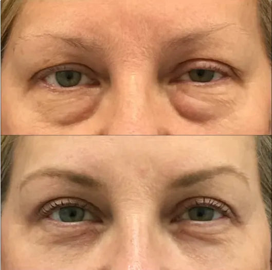 🔥 FINAL CLEARANCE: 50% OFF THE LUMI EYE RENEWAL — JUST $39.99! 🔥